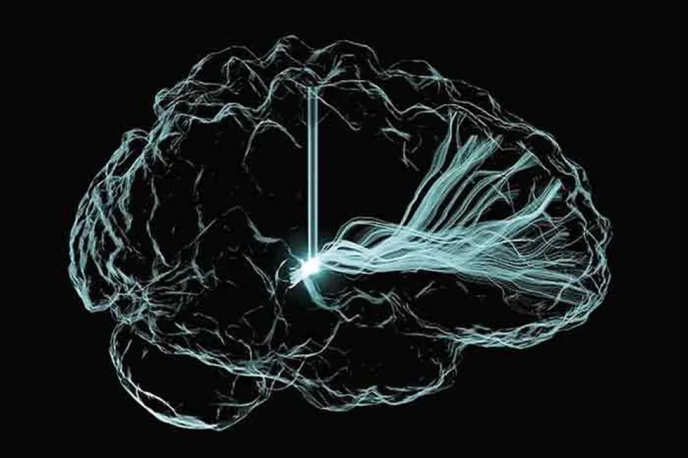 Los implantes cerebrales ayudan a mejorar las habilidades cognitivas después de sufrir una lesión traumática
