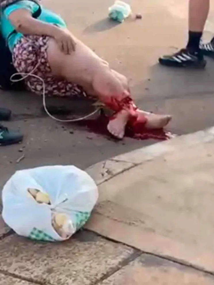 Sufrió una fractura expuesta grave