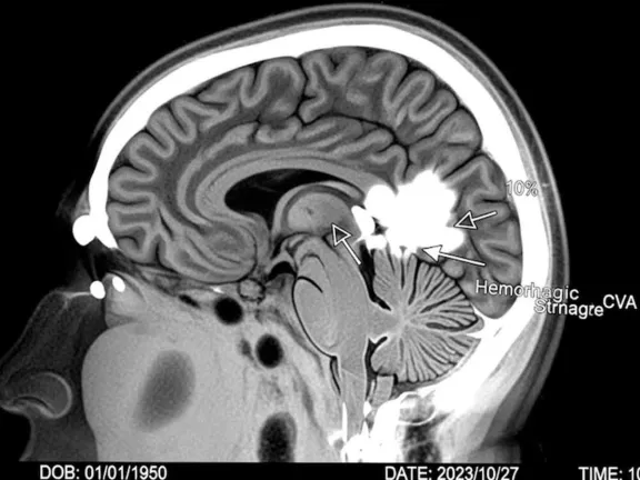 Robótica a distancia e <b>inteligencia artificial</b>: el futuro del tratamiento ante el ACV? thumbnail